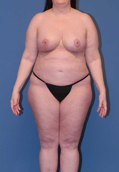 Liposuction Before & After Image