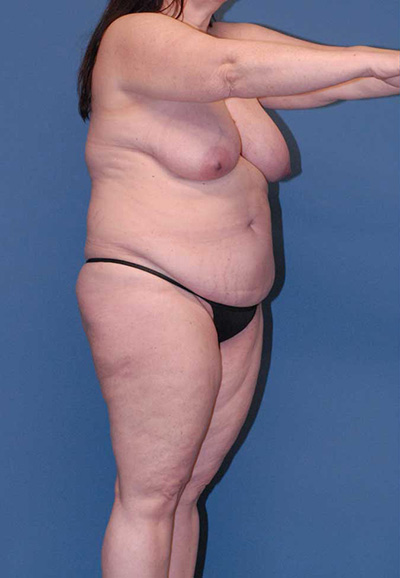 Liposuction Before & After Image