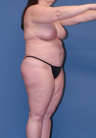 Liposuction Before & After Image