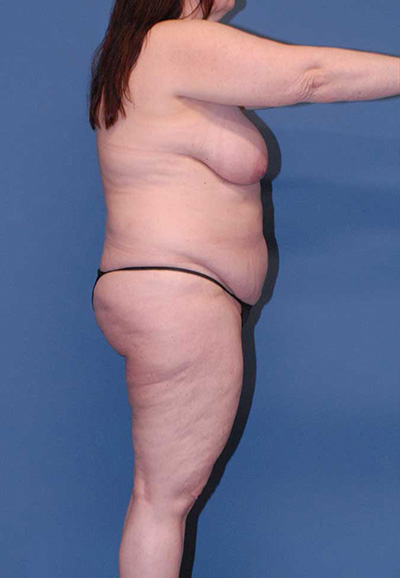Liposuction Before & After Image