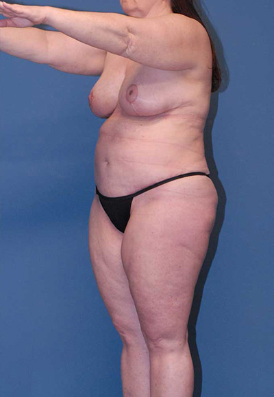 Liposuction Before & After Image