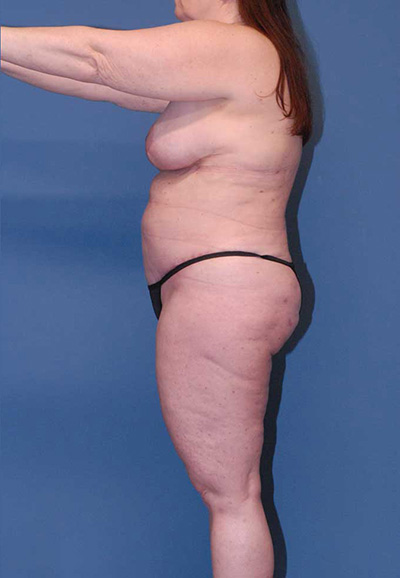 Liposuction Before & After Image