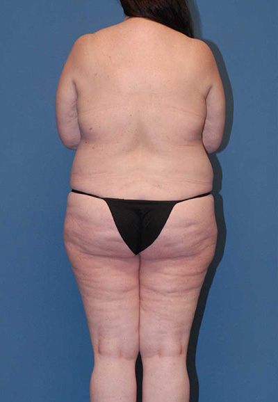 Liposuction Before & After Image