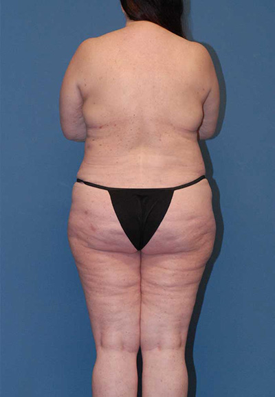 Liposuction Before & After Image