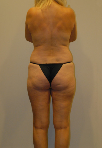 Liposuction Before & After Image