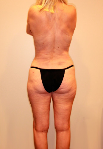 Liposuction Before & After Image