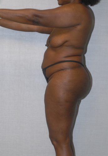 Liposuction Before & After Image