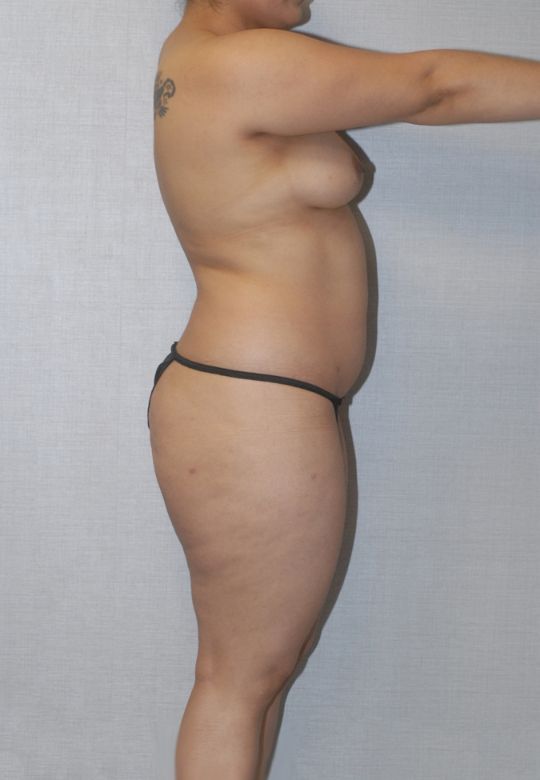 Liposuction Before & After Image