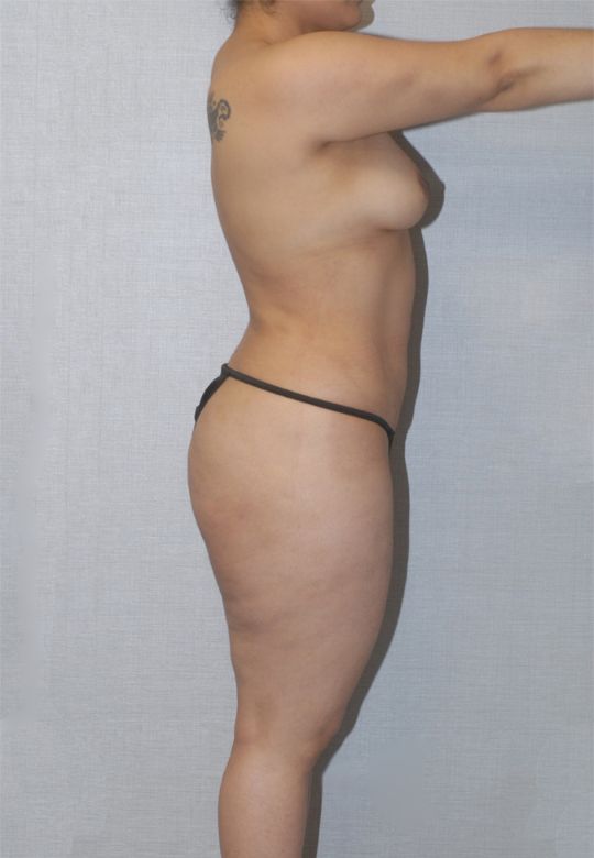 Liposuction Before & After Image