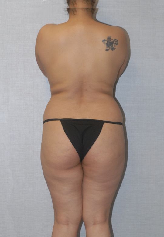 Liposuction Before & After Image