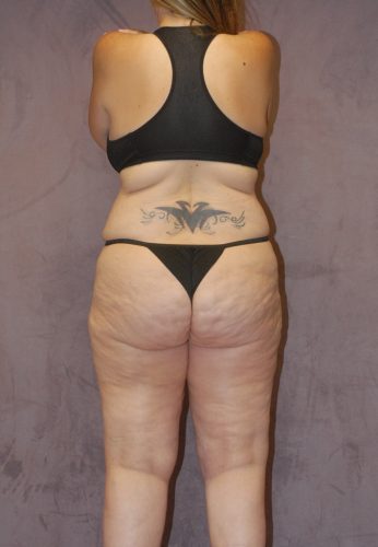 Liposuction Before & After Image