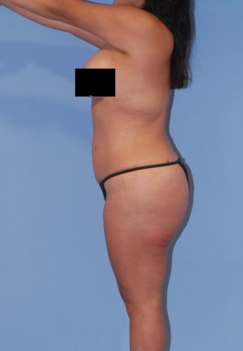 Liposuction Before & After Image