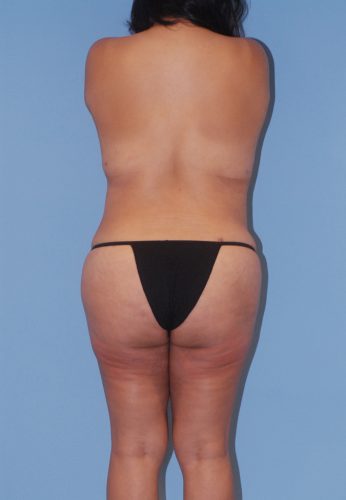 Liposuction Before & After Image