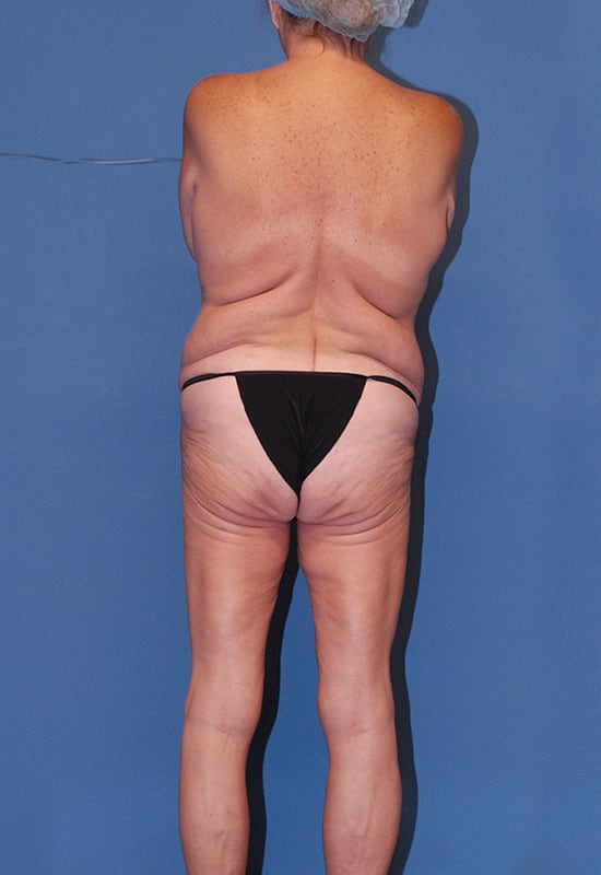 Lower Body Lift Before & After Image