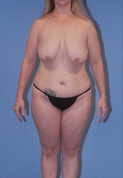 Mommy Makeover Before & After Image