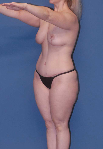 Mommy Makeover Before & After Image