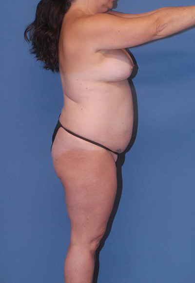 Mommy Makeover Before & After Image