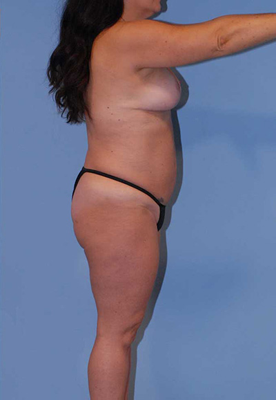 Mommy Makeover Before & After Image