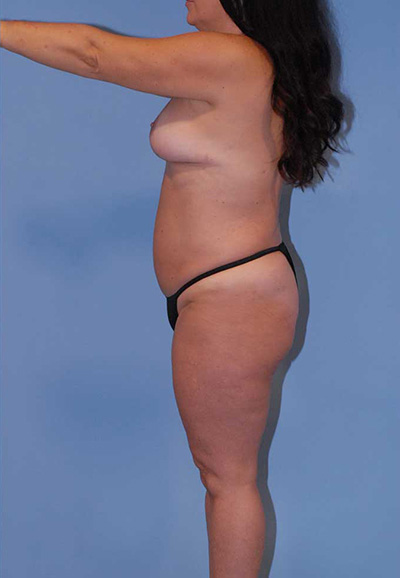 Mommy Makeover Before & After Image