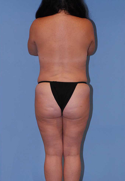 Mommy Makeover Before & After Image