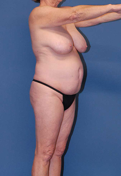 Mommy Makeover Before & After Image