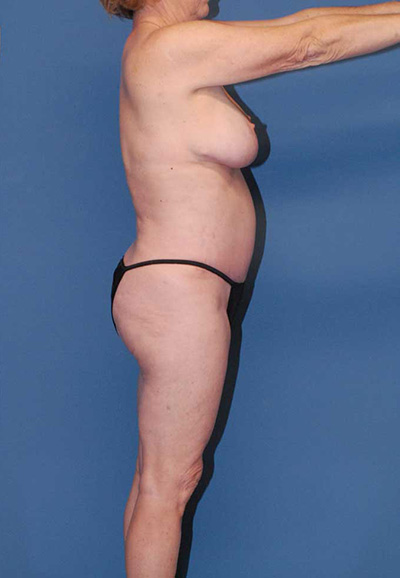 Mommy Makeover Before & After Image