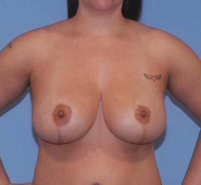Mommy Makeover Before & After Image