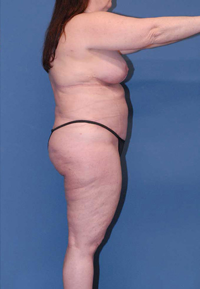 Mommy Makeover Before & After Image
