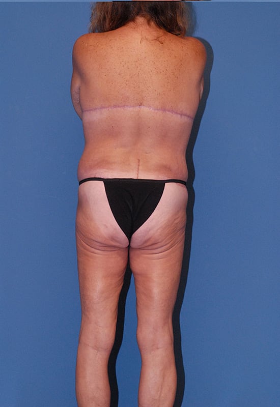 Torsoplasty (Upper Body Lift) Before & After Image