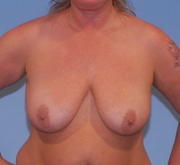 Breast Augmentation And Lift Before & After Image