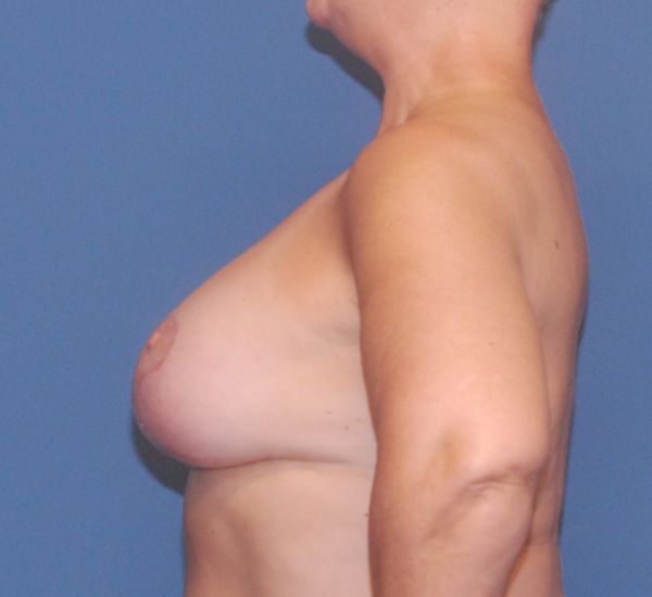 Breast Augmentation And Lift Before & After Image