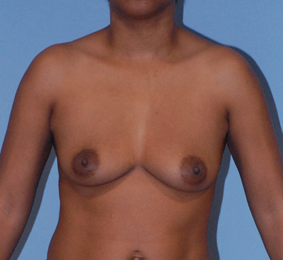 Breast Augmentation  Before & After Image