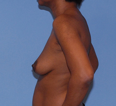 Breast Augmentation  Before & After Image