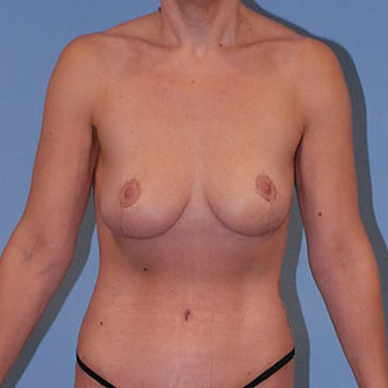 Breast Augmentation  Before & After Image