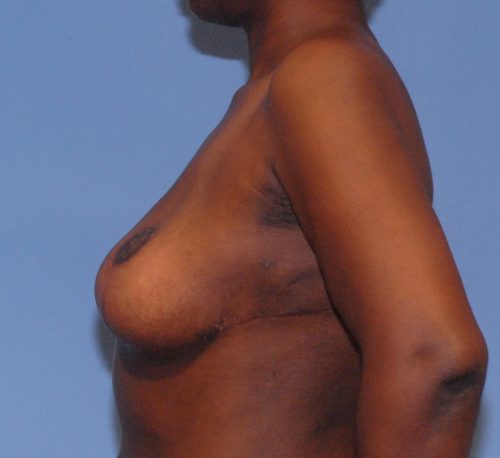 Breast Corrections & Revisions Before & After Image