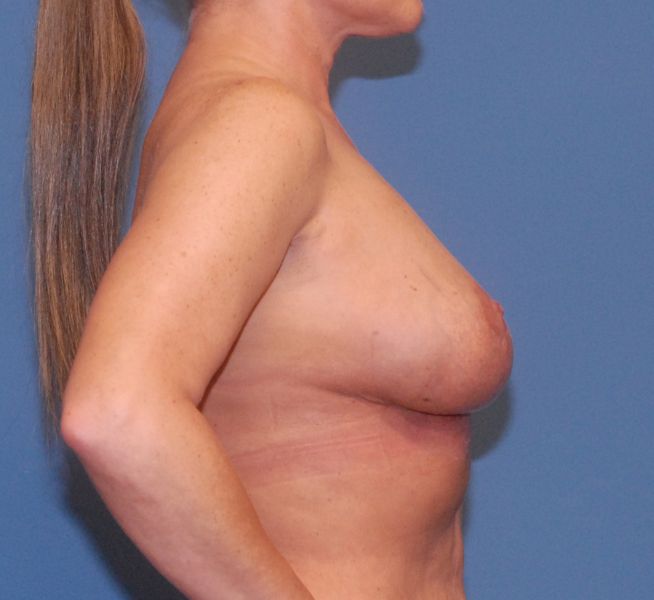 Breast Corrections & Revisions Before & After Image