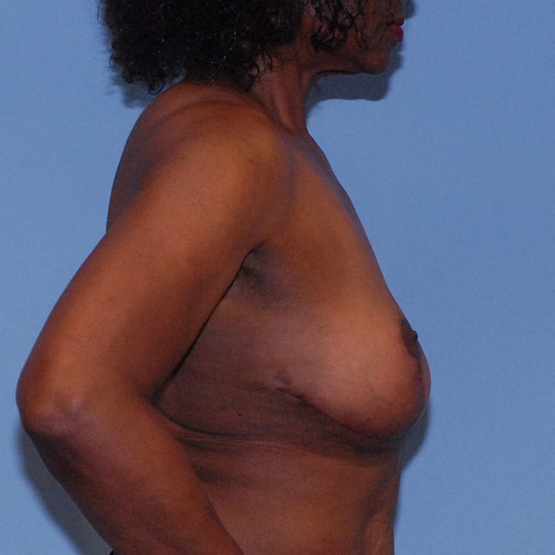 Breast Corrections & Revisions Before & After Image