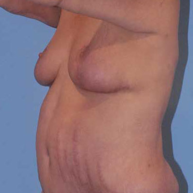 Breast Lift Before & After Image