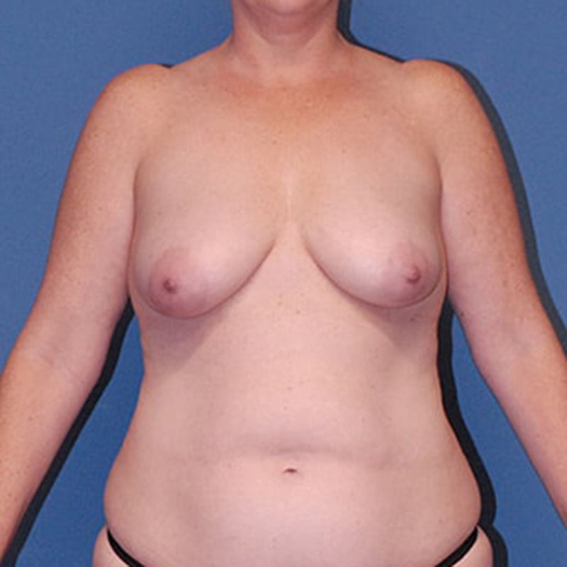 Breast Lift Before & After Image