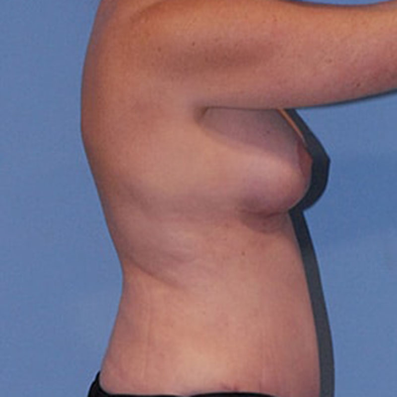 Breast Lift Before & After Image