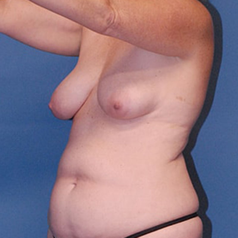 Breast Lift Before & After Image