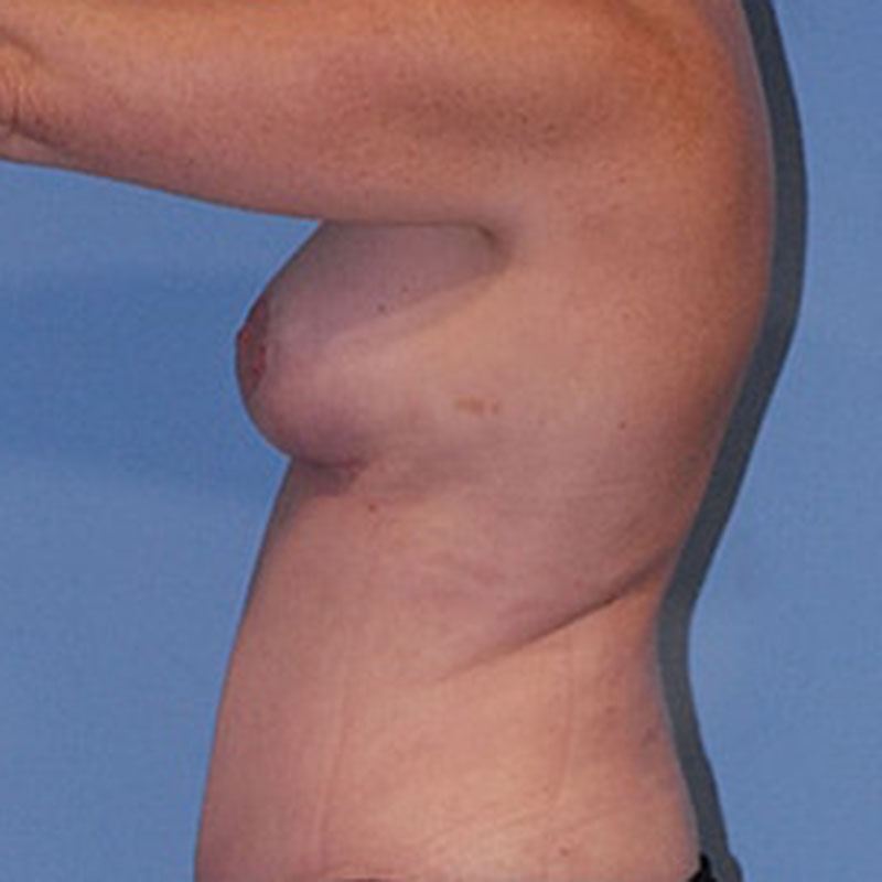 Breast Lift Before & After Image