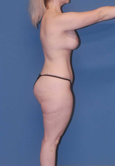 Breast Lift Before & After Image