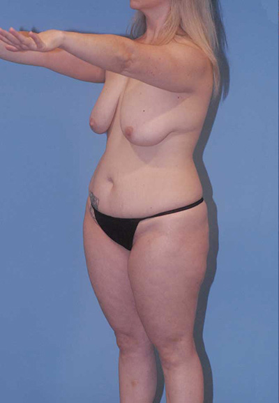 Breast Lift Before & After Image