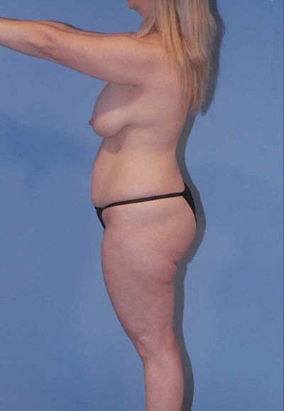 Breast Lift Before & After Image