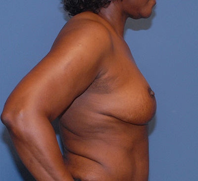Breast Lift Before & After Image