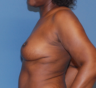 Breast Lift Before & After Image