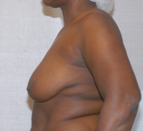 Breast Reduction And Lift Before & After Image