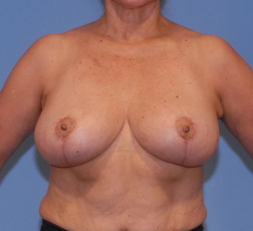 Breast Reduction And Lift Before & After Image