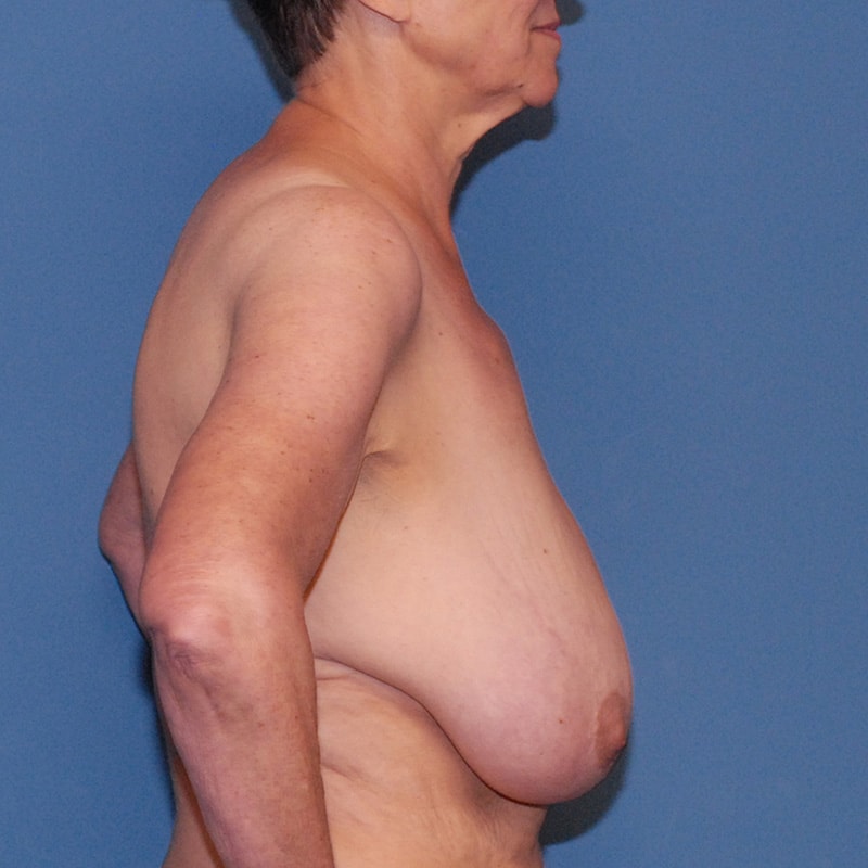 Breast Reduction And Lift Before & After Image